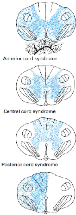 Gambar 3.  Potongan melintang dari korda spinalis,  menunjukkan  sindroma  cedera  medula  spinalis  parsial 