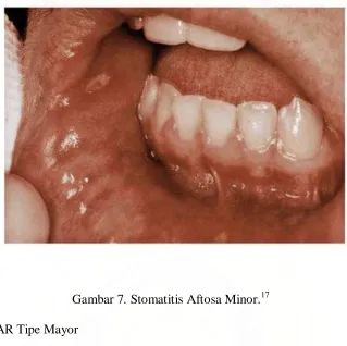 Gambar 7. Stomatitis Aftosa Minor.17 