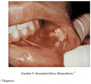 Gambar 9. StomatitisAftosa Herpetiform.17 