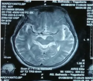 Gambar 1. Foto MRI kepala