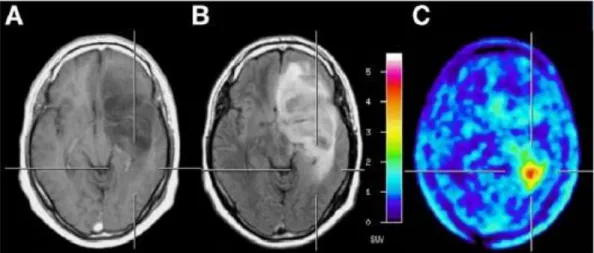 Gambar  1. Hasil  Scan pada  Tumor  Otak. A) MRI-T1.  B) MRI-T2.  C) PET  (Herholz  et al.,  2014) 