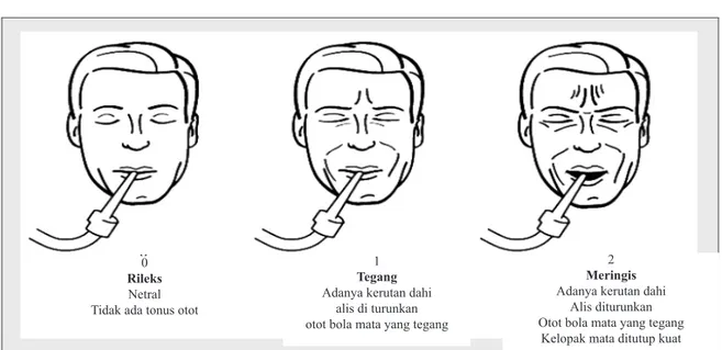 Gambar 1 Ekspresi wajah pada crtitical pain observation tool