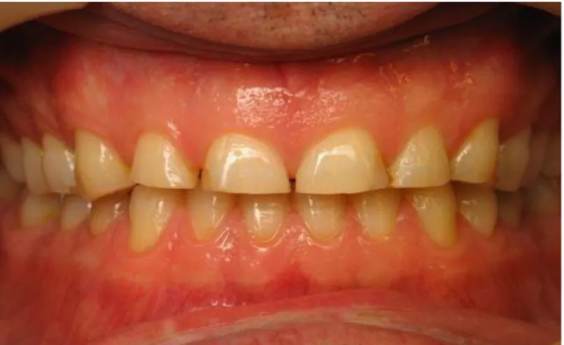 Gambar 4. Tampilan klinis gigi yang mengalami erosi 4 