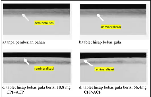 Gambar  2.5. Gambaran mikroradiograf menunjukkan remineralisasi lesi subsurface  email dengan tablet hisap  bebas gula yang berisi CPP-ACP  (Cai et.al.,  2009) 