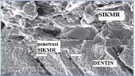 Gambar 2.5. Gambar SEM Permukaan SIKMR dengan Dentin, Penetrasi SIKMR ke dalam  Tubulus Dentin (Preenan, 2004) 