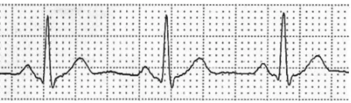 Gambar 6 Hasil proses grayscale data jantung normal  4.1.2 Segmentasi 