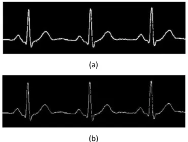 Gambar 8 Hasil perbaikan morfologi citra data jantung normal. (a) Hasil Dilasi  (b) Hasil Ero 