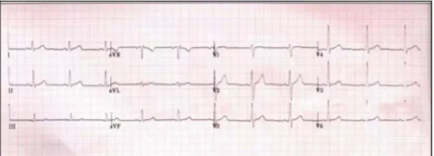 Gambar 1. Contoh Pola EKG 12 sandapan  2.3  EKG pada Infark Miokard 
