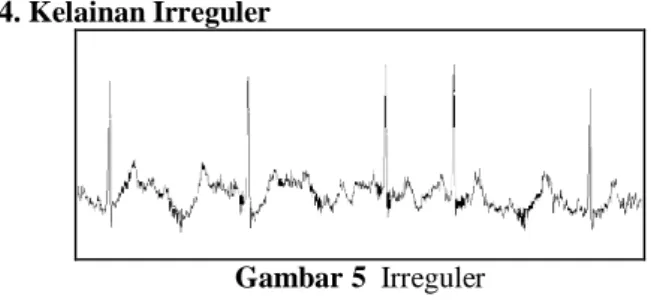 Gambar 2 Normal Sinus Rhythm 