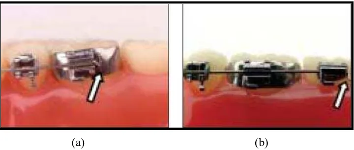 Gambar 10. Bagian distal dari archwire di-cinched back di bagian molar tube  (a) pada molar pertama mandibula, (b) pada molar kedua mandibula.22 