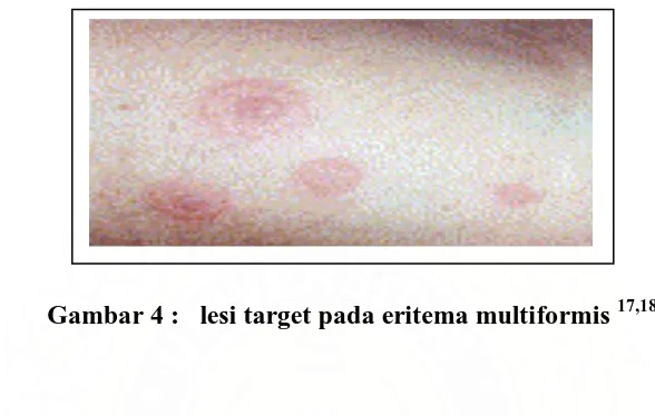 Gambar 4 :   lesi target pada eritema multiformis 17,18 