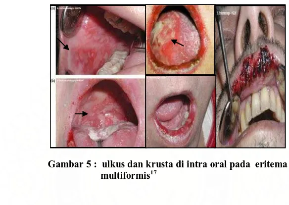 Gambar 5 :  ulkus dan krusta di intra oral pada  eritema                multiformis17  