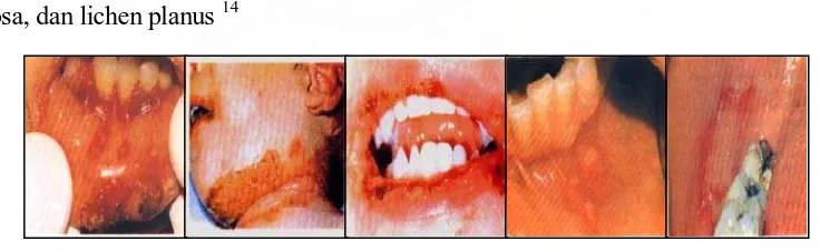 Gambar 10 :   kiri-kanan : infeksi herpes simpleks, pemphigus vulgaris pada leher             anak,  pemphigus vulgaris labialis,  ulkus apthosa, lichen planus 2 
