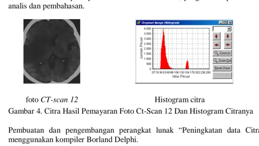 Gambar 4. Citra Hasil Pemayaran Foto Ct-Scan 12 Dan Histogram Citranya 