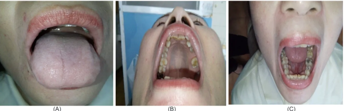 Gambar 2. (A) Dorsum lidah, (B) palatum, dan (C) dasar mulut pasien BMS pada kunjungan kedua
