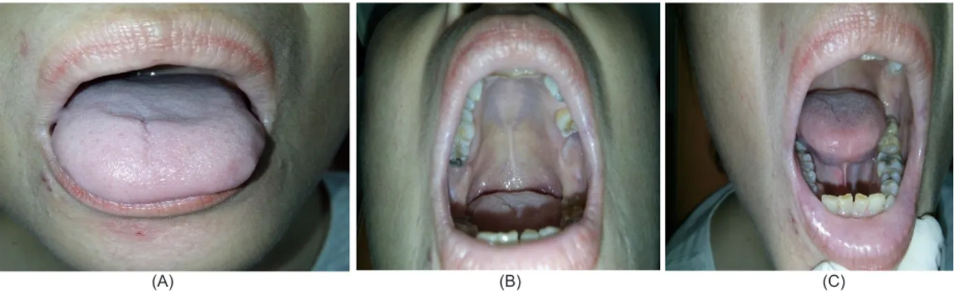 Gambar 3 memperlihatkan dorsum lidah  (3 A), palatum (3 B), dan dasar mulut (3 C) tidak  terdapat perubahan yang jelas secara klinis, hanya  pada kunjungan ketiga ini pasien merasakan  perbaikan dibandingkan kondisi awalnya, dan pada  saat ini pasien sudah