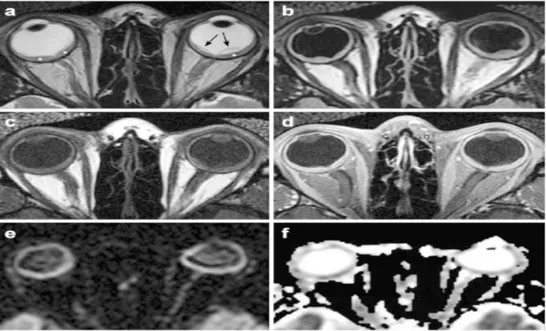 Gambar 12. Panuveitis Bilateral pada Sindrom VKH. (A) T2W1 Potongan Aksial,  (B) Gambaran FLAIR, (C) T1W1 (D) T1W1 dengan Kontras dan  Saturasi Lemak