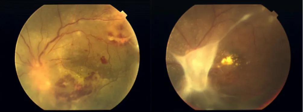 Gambar 4.  Vaskulitis Retina,Oklusi Vena dan Granuloma Optic Disk  akibat Infeksi TB. (kiri)  Sebelum  Tatalaksanan  (kanan)  Setelah 3 Bulan Tatalaksana