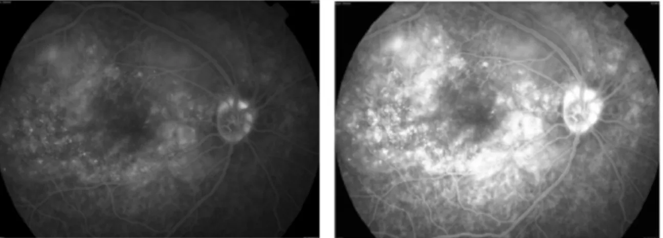 Gambar 7.  (Kiri) Hasil FFA di Mata Kanan pada Fase Akhir   Menunjukkan Hiperfluoresensi  Pungtata dan Multipel dengan Penumpukan Zat Warna yang Menunjukkan Serous  Retinal Detachment dan Hiperfluoresensi di Optic Disk
