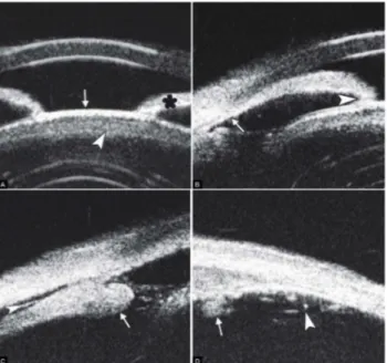 Gambar 10. Uveitis Intermediet pada UBM Optical Coherence Tomography 