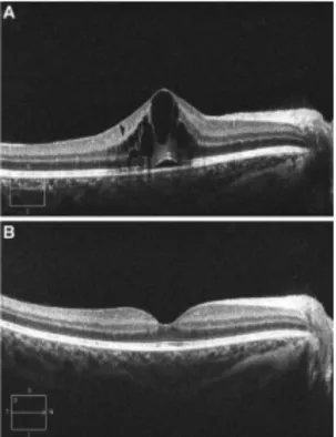 Gambar 11. Hasil HD-SDOCT pada (A) Edema  Makula Kistik dan Serous Retinal  Detachment (B) Resolusi Setelah  Tata Laksana 10 