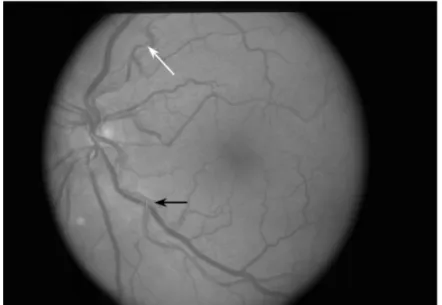 Gambar  berdasarkan  klasifikasi  retinopati  hipertensi  menurut  Wong  dan  McIntosh 