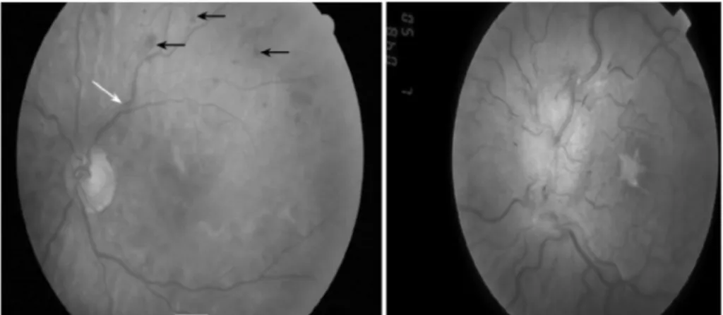 Gambar 2.2 (kiri) Retinopati hipertensi derajat sedang: perdarahan retina  (panah hitam), penebalan arteri vena (panah putih), penyempitan  menyeluruh arteriol retina.Gambar 2.3 (kanan) keganasan retinopati yang  dipercepat : penebalan diskus optic, perdar