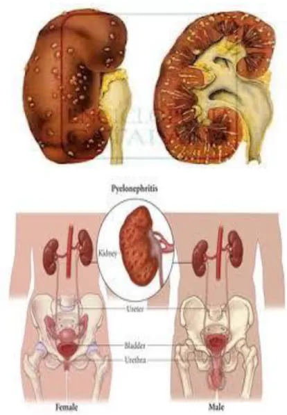 Gambar 2.2 Pielonefritis