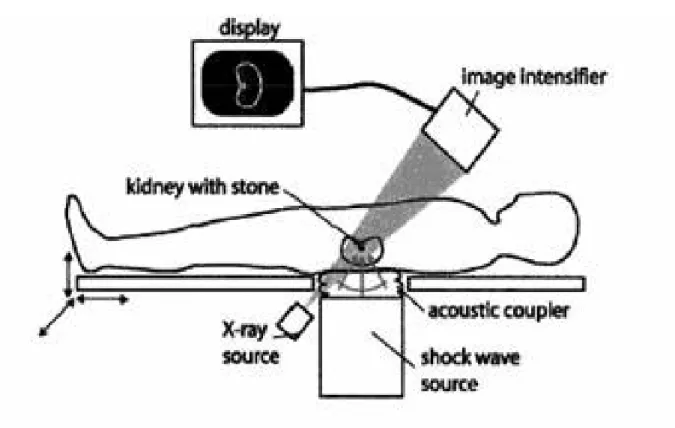 Gambar Diagram skematik ESWL : 
