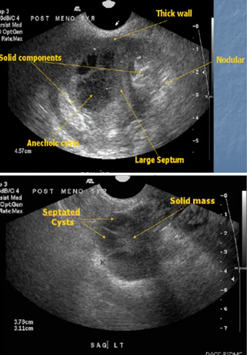 Gambar	2. Massa solid dan abnormal vaskularisasi  ovarium kanan pada CDI. 7