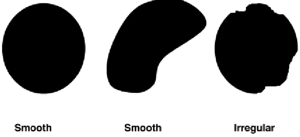 Gambar 2.2. Dinding kista digambarkan sebagai smooth atau irregular 31 