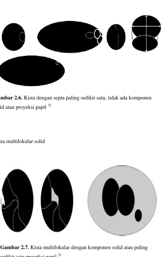 Gambar 2.6. Kista dengan septa paling sedikit satu, tidak ada komponen  solid atau proyeksi papil  31