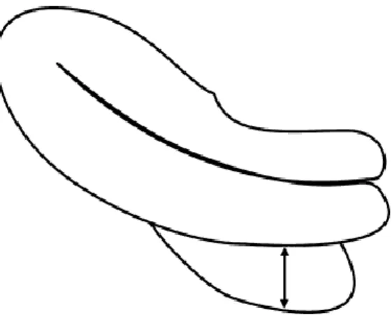 Gambar 2.13. Cairan pada cul-de-sac diukur pada potongan sagital dan diameter  anteroposterior terbesar (mm)  31 