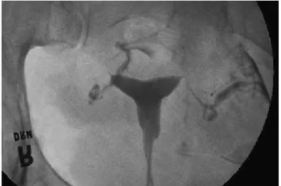 Gambar  1.  Histerosalpingogram.  Infusi  larutan  kontras  radiografik  ke  dalam  uterus  dan  tuba  fallopi menggunakan panduan fluoroskopik
