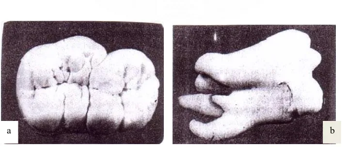 Gambar 3 a dan b. Dua contoh gigi fusi posterior pada gigi permanen. 17