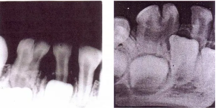 Gambar 4 b. Gambar gigi fusi          gigi permanen rahang  