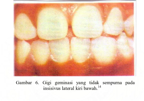 Gambar 6. Gigi geminasi yang tidak sempurna pada insisivus lateral kiri bawah.14 