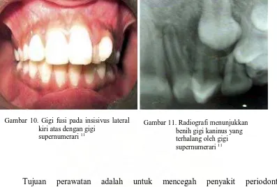 Gambar 10. Gigi fusi pada insisivus lateral       kiri atas dengan gigi     