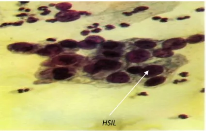 Gambar 15. High-grade Squamous Intraepithelial Lesion  (Lestadi, 2009) 