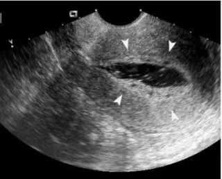 Gambar 2.5. Gambaran hiperplasia endometrium pada SIS (Dikutip dari Berridge  dan Winter, 2004) 5 
