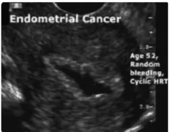 Gambar  2.6.  Gambaran  kanker  endometrium  pada  SIS  (Dikutip  dari  Parsons,  2001) 3 
