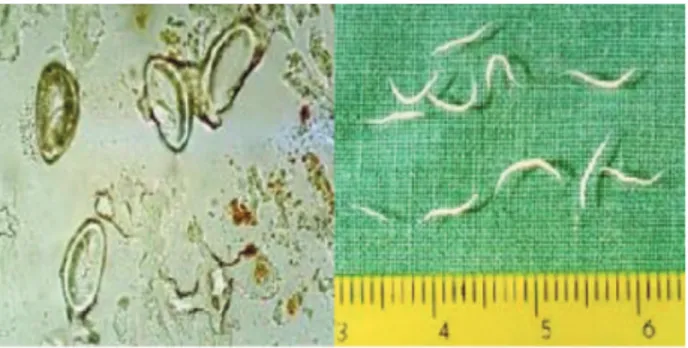 Gambar 1.  Telur dan bentuk dewasa E. vermicularis Dikutip dari: Huh S. Pinworm. http://www.emedicine.com/med/topic 1837.htm