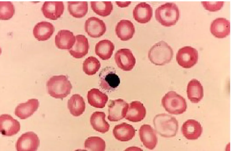 Gambar 2.1. Morfologi eritrosit penderita Thalassemia (Lichtman’s Atlas of Hematology)