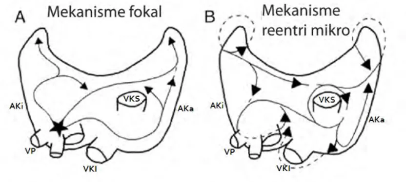Gambar  1. Mekanisme elektrofisiologis FA. A. Mekanisme fokal: fokus/pemicu (tanda  bintang)  sering  ditemukan  di  vena  pulmoner