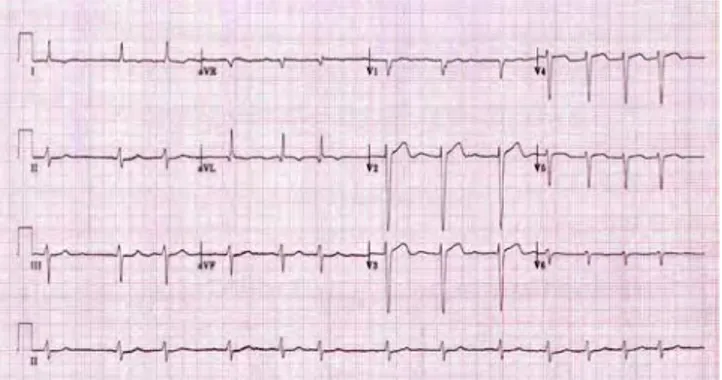 Gambar  4.  Rekaman  EKG  FA.  A.  FA  dengan  respon  ventrikel  normal,  B.  FA  dengan  respon ventrikel cepat, C