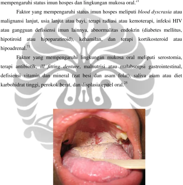 Gambar 2.9. Kandidiasis Oral yang Nampak sebagai Bercak Putih   pada Permukaan Lidah dan Palatum Lunak
