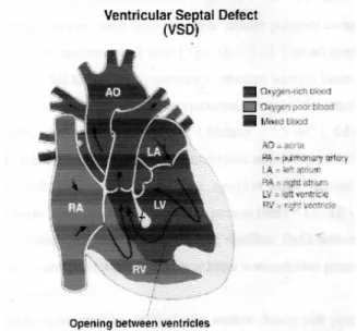 Gambar EKG pada VSD 