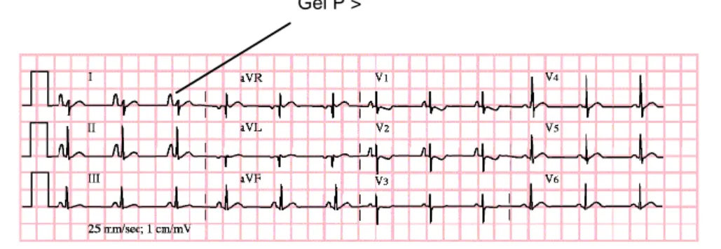 Gambar 19.  EKG Pembesaran atrium kanan  Ket: tampak gel T yang tinggi di lead I 
