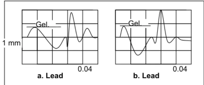 Gambar 1. Gelombang P normal pada lead II dan  V1  4