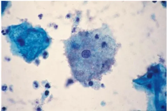 Gambar 2.7. Mikroskop Vaginosis Bakterial  Sumber: Pathology Outlines (2013) 